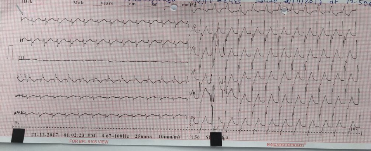 Tachycardia With RBBB Chest Uneasiness, Sweating Tiredness